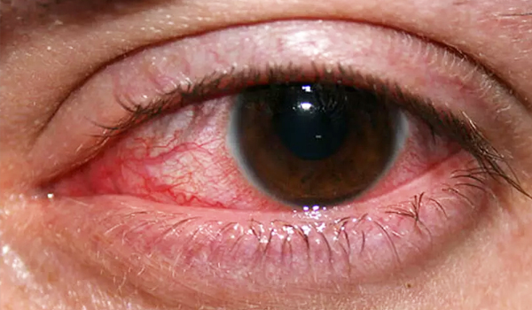 ചെങ്കണ്ണ് രോഗത്തെ പ്രതിരോധിക്കാം