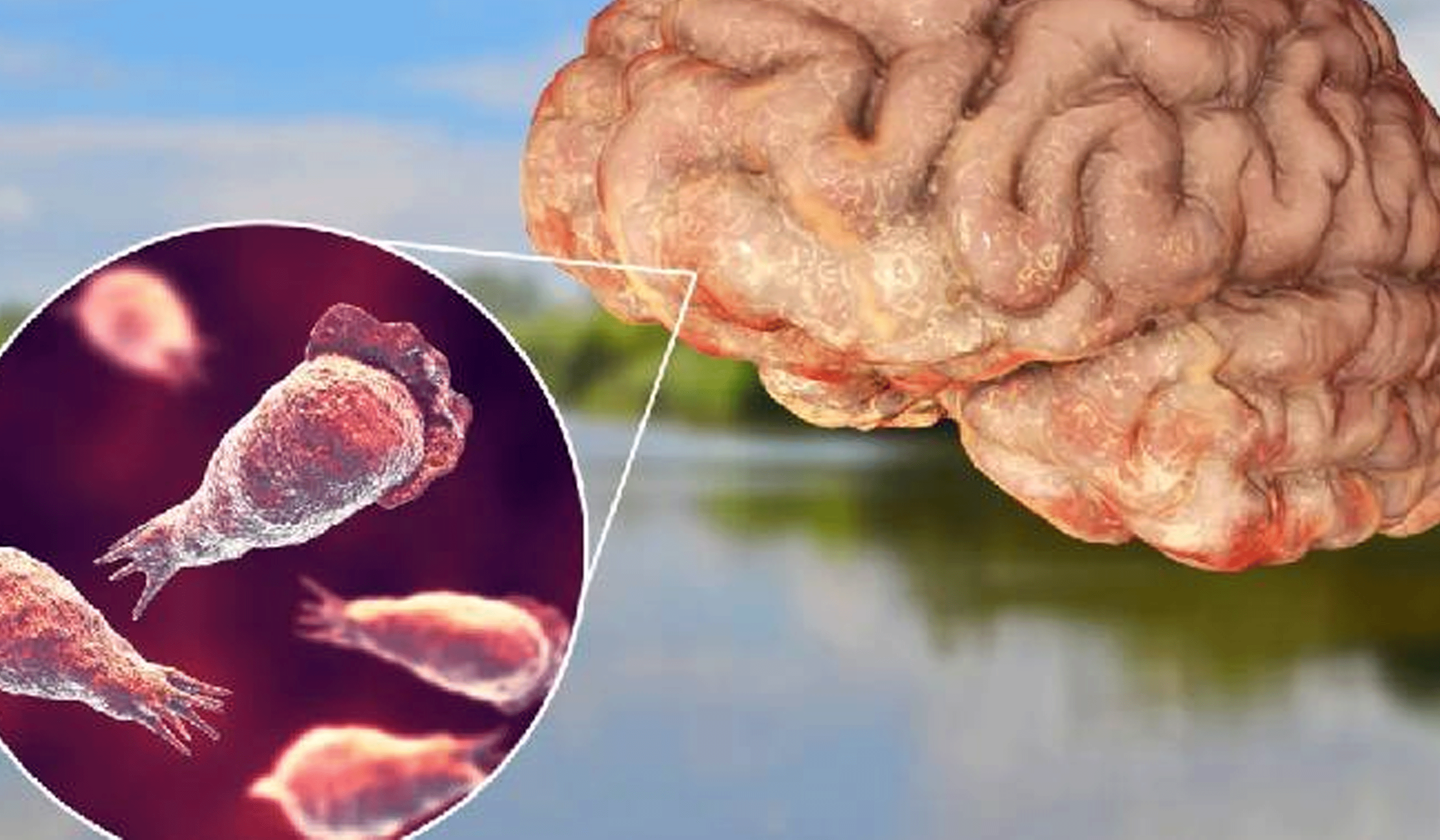 അമീബിക് മസ്തിഷ്‌ക ജ്വരം: ചികിത്സയില്‍ ആയിരുന്ന വയനാട് മാനന്തവാടി സ്വദോശി മരിച്ചു